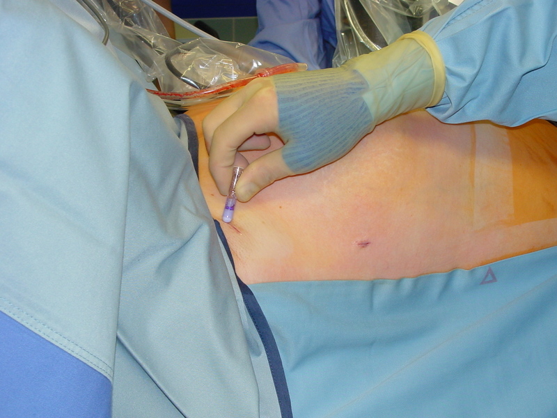 Endoskopische transthorakale Sympathektomie - Operationssituation