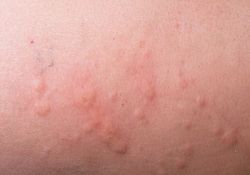 allergische Hautreizung