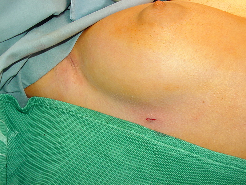 Endoskopische transthorakale Sympathektomie - minimalinvasiver chirurgischer Operationseingriff