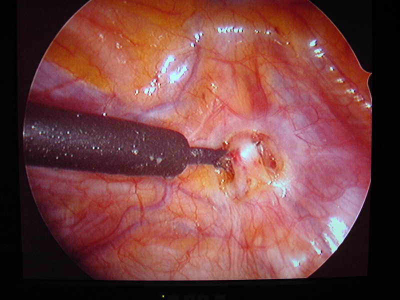Endoskopische transthorakale Sympathektomie - elektronenmiskroskopische Aufnahme